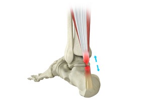 Achilles Tendon Rupture