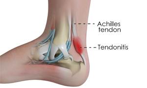 Achilles Tendonitis