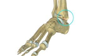 Ankle Impingement