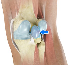 Baker’s Cyst