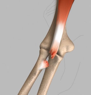 Biceps Tendon Tear at the Elbow