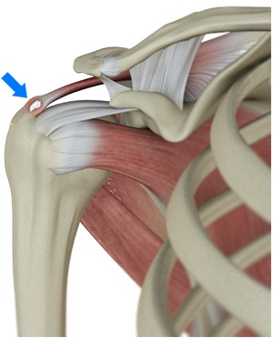 Calcific Cuff Tendinopathy