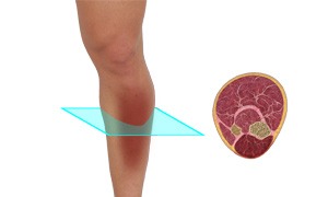 Compartment Syndrome