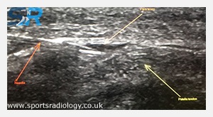 Dry Needling and Autologous Blood Injections