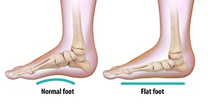 Flat Foot