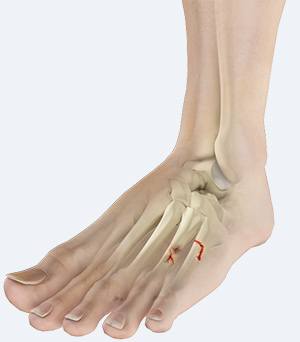 Forefoot Fractures