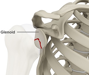 Glenoid Fracture