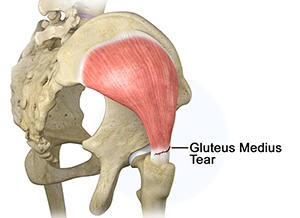 Gluteal Muscle Tear