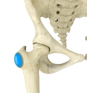 Greater Trochanteric Bursitis