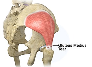 Hip Muscle Strain