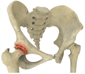 Hip Osteoarthritis