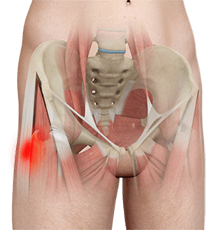 Hip Tendonitis