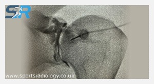 Hydrodilatation