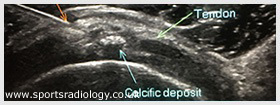 Image Guided Calcific Barbotage