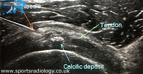 Image Guided Calcific Barbotage