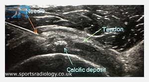 Image Guided Calcific Barbotage