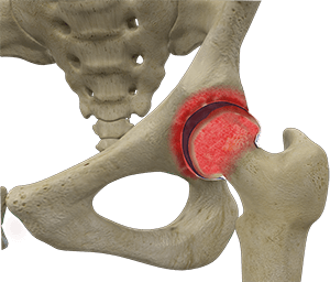 Inflammatory Arthritis