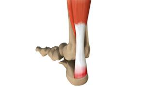 Insertional Achilles Tendonitis