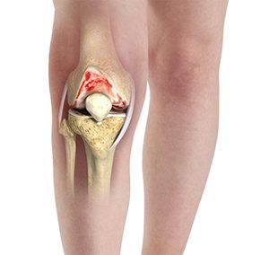 Osteoarthritis