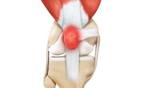 Kneecap Bursitis