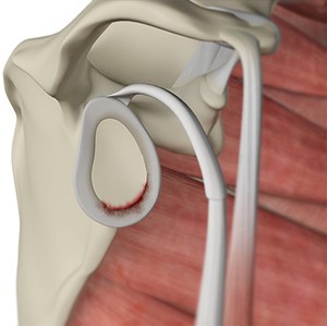 Labral Tears