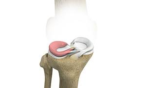 Lateral Meniscus Syndrome