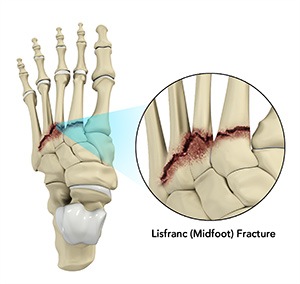 Lisfranc Fracture