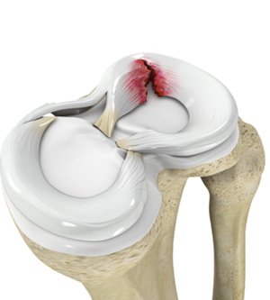 Meniscal Tear