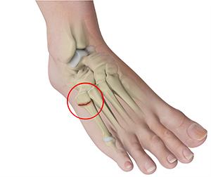 Metatarsal Fracture