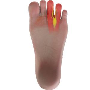 Morton’s Neuroma