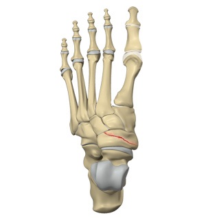 Navicular Fracture