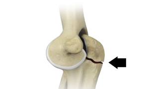 Olecranon Bursitis