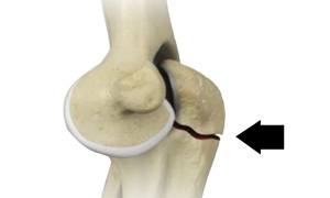 Olecranon (Elbow) Fractures