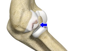 Osteochondritis Dissecans