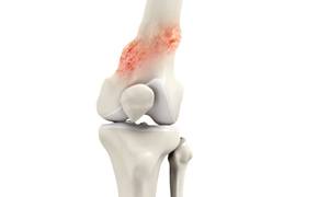 Osteochondroma