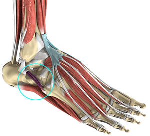 Peroneal Tendonitis