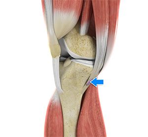 Pes Anserine Bursitis