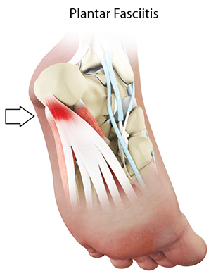 Plantar Fasciitis