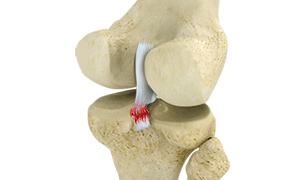 Posterior Cruciate Ligament Injuries