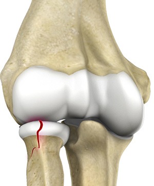 Radial Head Fractures