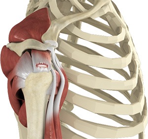 Rotator Cuff Tears