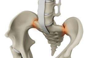 Sacroiliac Joint Dysfunction