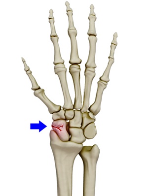 Scaphoid Fracture