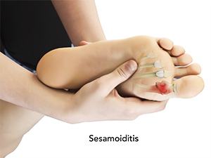 Sesamoiditis