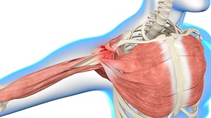 Shoulder Impingement