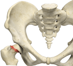 Slipped Capital Femoral Epiphysis