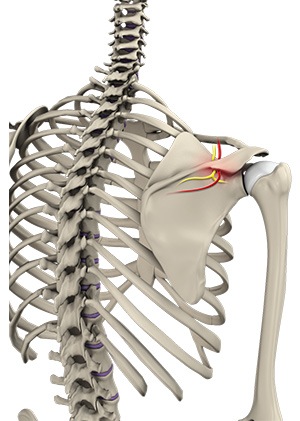 Suprascapular Neuropathy