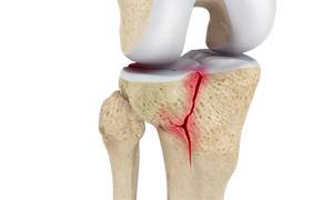 Tibial Plateau Fractures