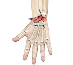 Wrist Arthritis